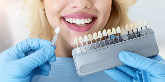 Dental Veneers