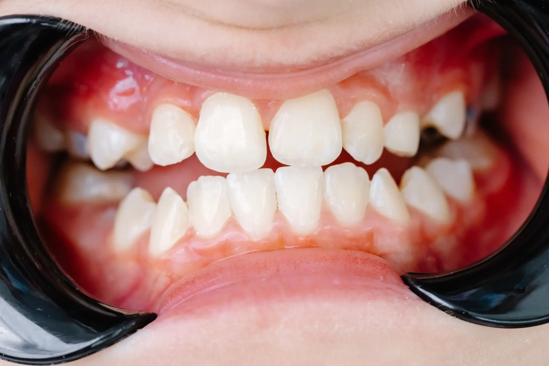 Gum Treatment