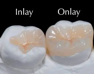 Fillings/Inlays and Onlays