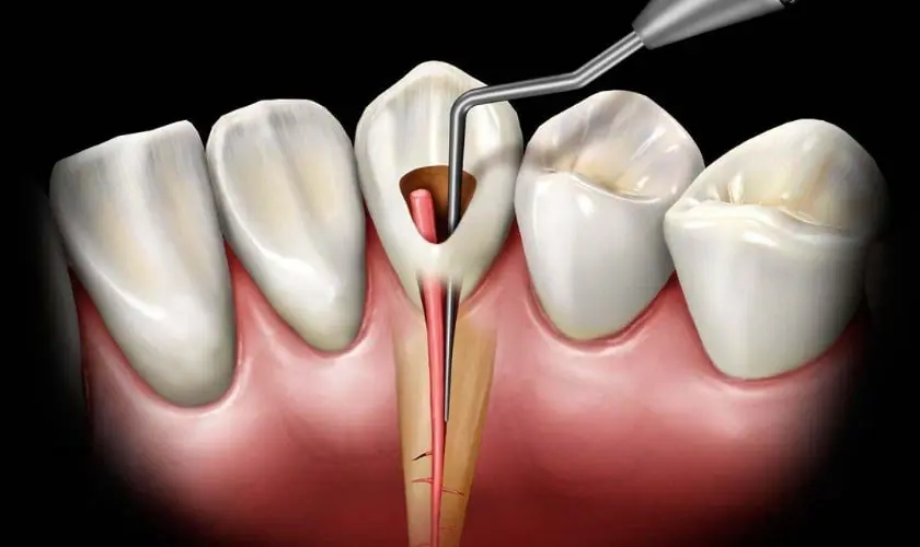 Root-Canal Treatment